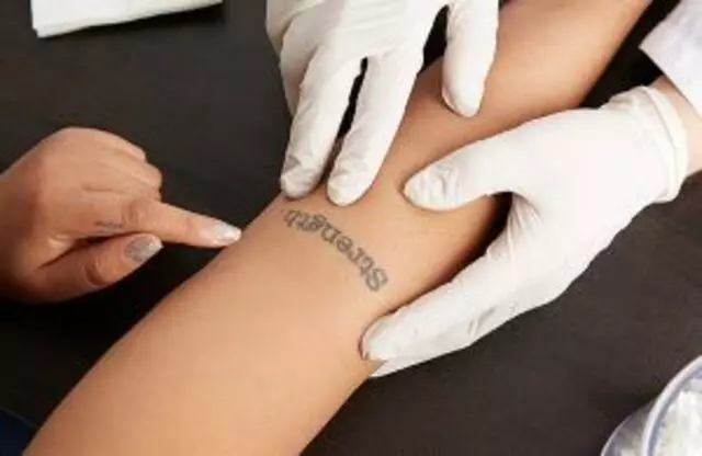 Anticipation Tattoo Removal